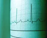 EKG z tętnem 94. Czy to norma? Wykres pokazuje rytm serca, a wynik 94 uderzeń na minutę jest w granicach normy dla dorosłych.